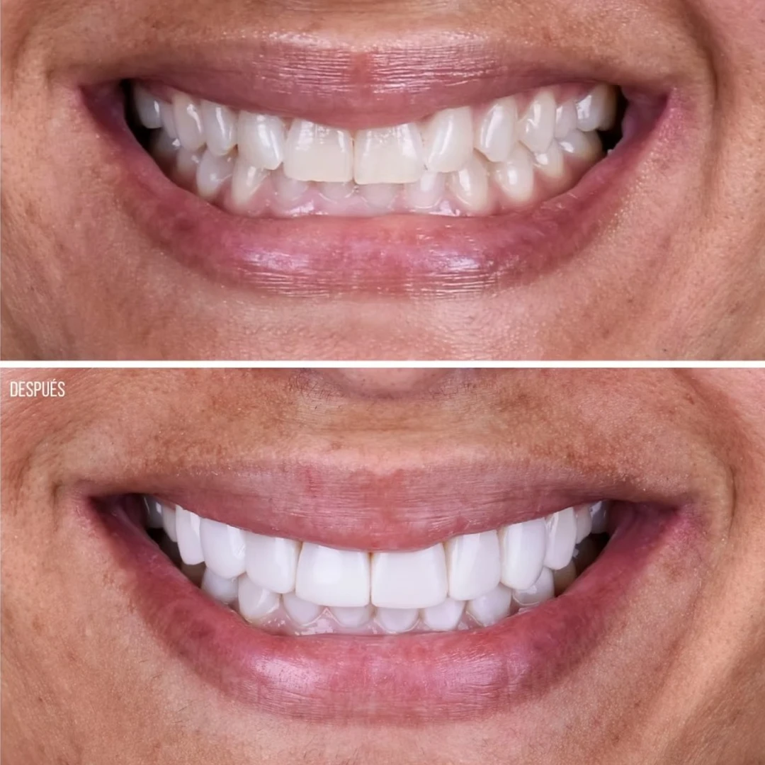 Ana Julia V., testimonial, before and after, Extreme Smile Makeover, Dr. Mariano Estrada, DDS, Santo Domingo