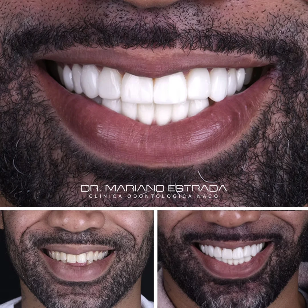 Anthony D, testimonial, before and after, Extreme Smile Makeover, Dr. Mariano Estrada, DDS, Santo Domingo