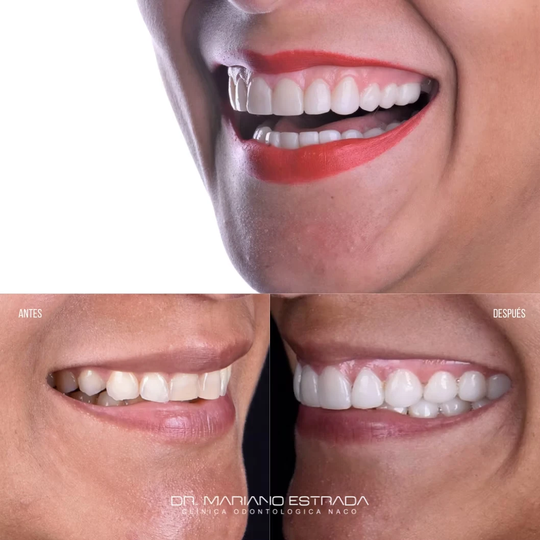 A New Smile in 1 Day by Dr. Mariano Estrada - Center for Implants & Dental Aesthetics | Santo Domingo, Dominican Republic, before & after