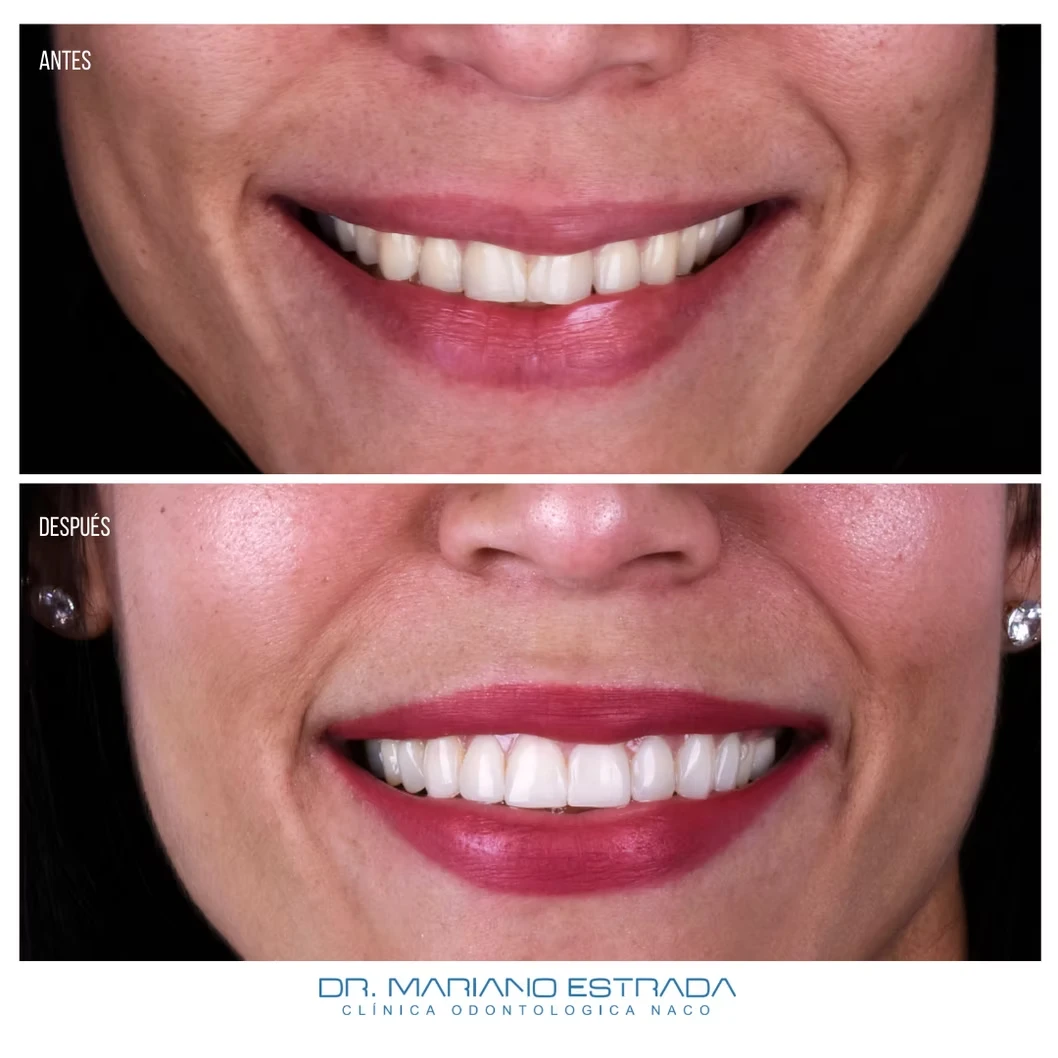 A New Smile in 1 Day by Dr. Mariano Estrada - Center for Implants & Dental Aesthetics | Santo Domingo, Dominican Republic, before & after