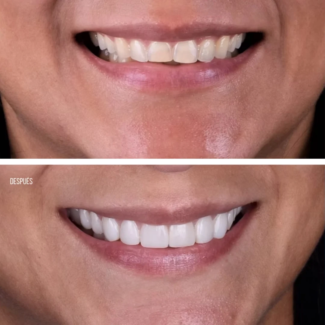 Caroline M., testimonial, before and after, Extreme Smile Makeover, Dr. Mariano Estrada, DDS, Santo Domingo