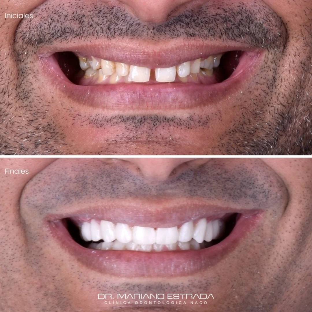Fernando S., testimonial, before and after, Extreme Smile Makeover, Dr. Mariano Estrada, DDS, Santo Domingo