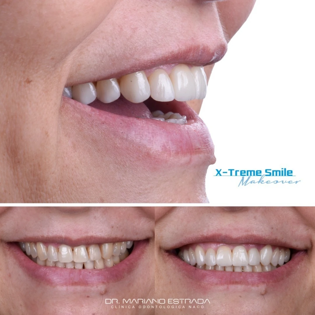 Gina C., testimonial, before and after, Extreme Smile Makeover, Dr. Mariano Estrada, DDS, Santo Domingo