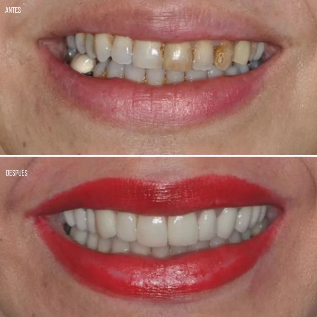 Isabel T., testimonial, before and after, Extreme Smile Makeover, Dr. Mariano Estrada, DDS, Santo Domingo