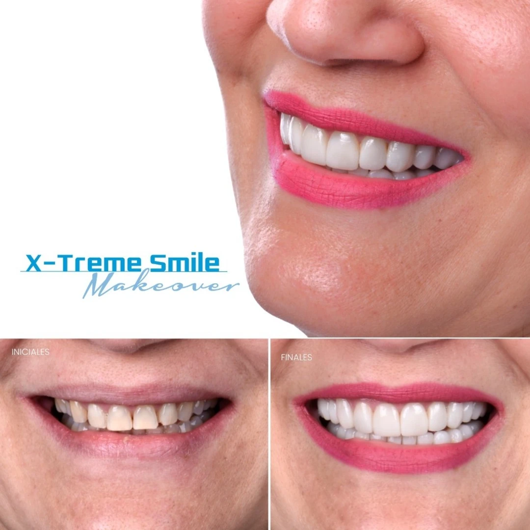Natalie V., testimonial, before and after, Extreme Smile Makeover, Dr. Mariano Estrada, DDS, Santo Domingo