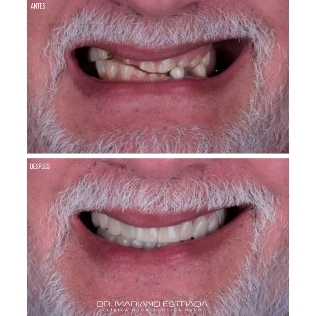 Richard P., testimonial, before and after, Extreme Smile Makeover, Dr. Mariano Estrada, DDS, Santo Domingo